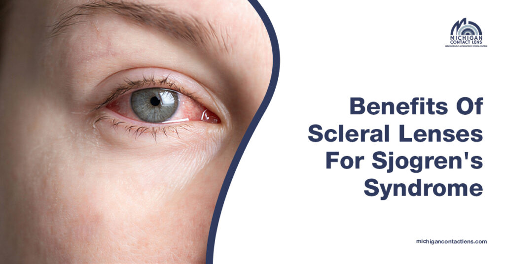 Benefits of Scleral Lenses for Sjogren's Syndrome