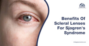Benefits of Scleral Lenses for Sjogren's Syndrome