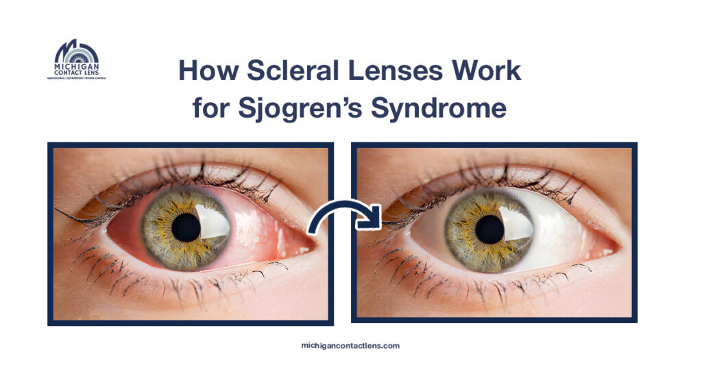 How Scleral Lenses Work for Sjogren's Syndrome