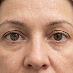 Close-up of both eyes, keratoconus often affecting one eye more than the other