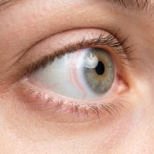 Faint red impression ring on the eye after removing a scleral lens